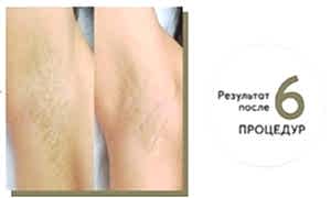 Результат фотоэпиляции после 6 процедур